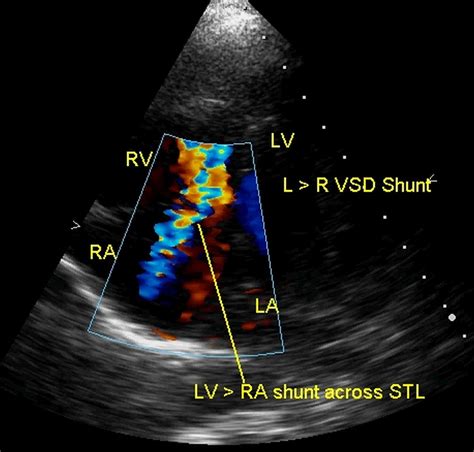 what is lv in cardiology.